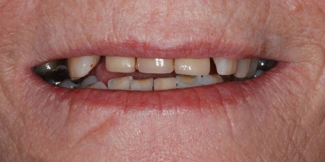 Bath spa dentistry same day teeth implants before