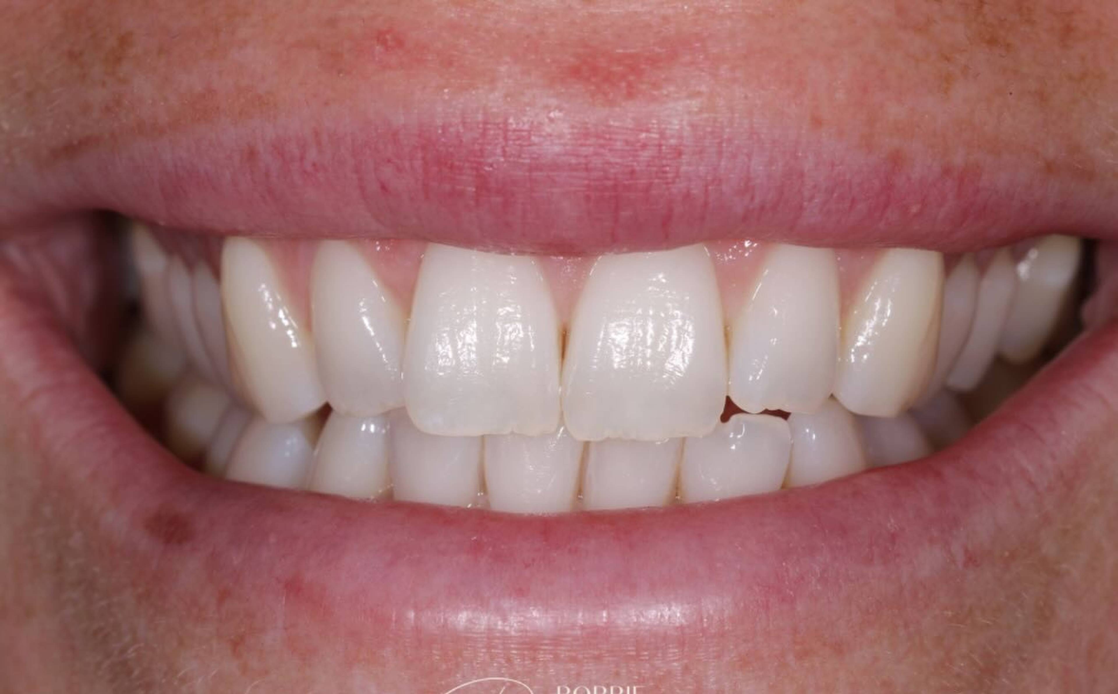 before subtle edge composite bonding by Robbie Thompson 