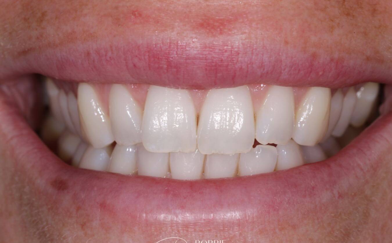 before subtle edge composite bonding by Robbie Thompson