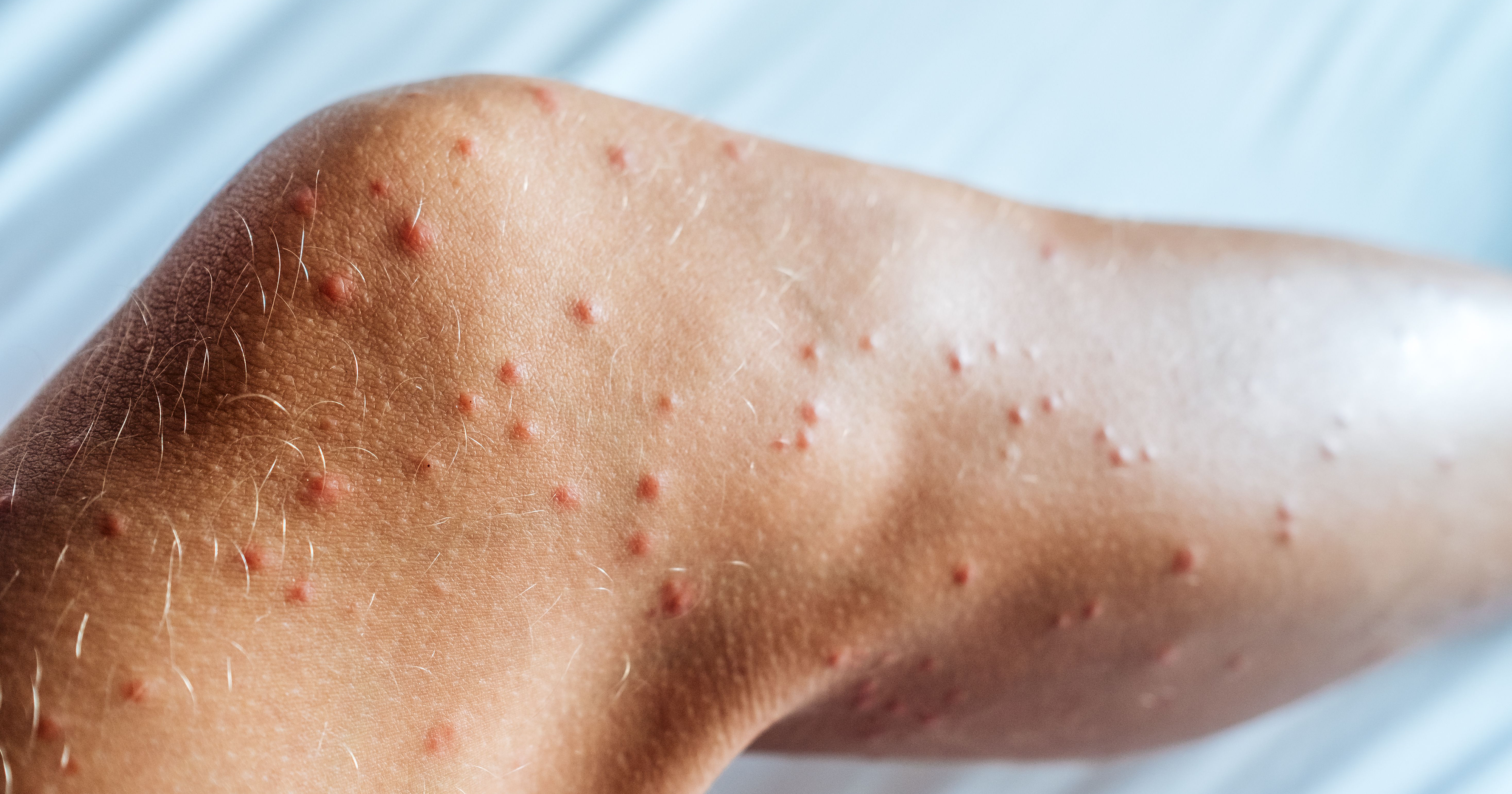 Bettwanzen rote Punkte am Bein