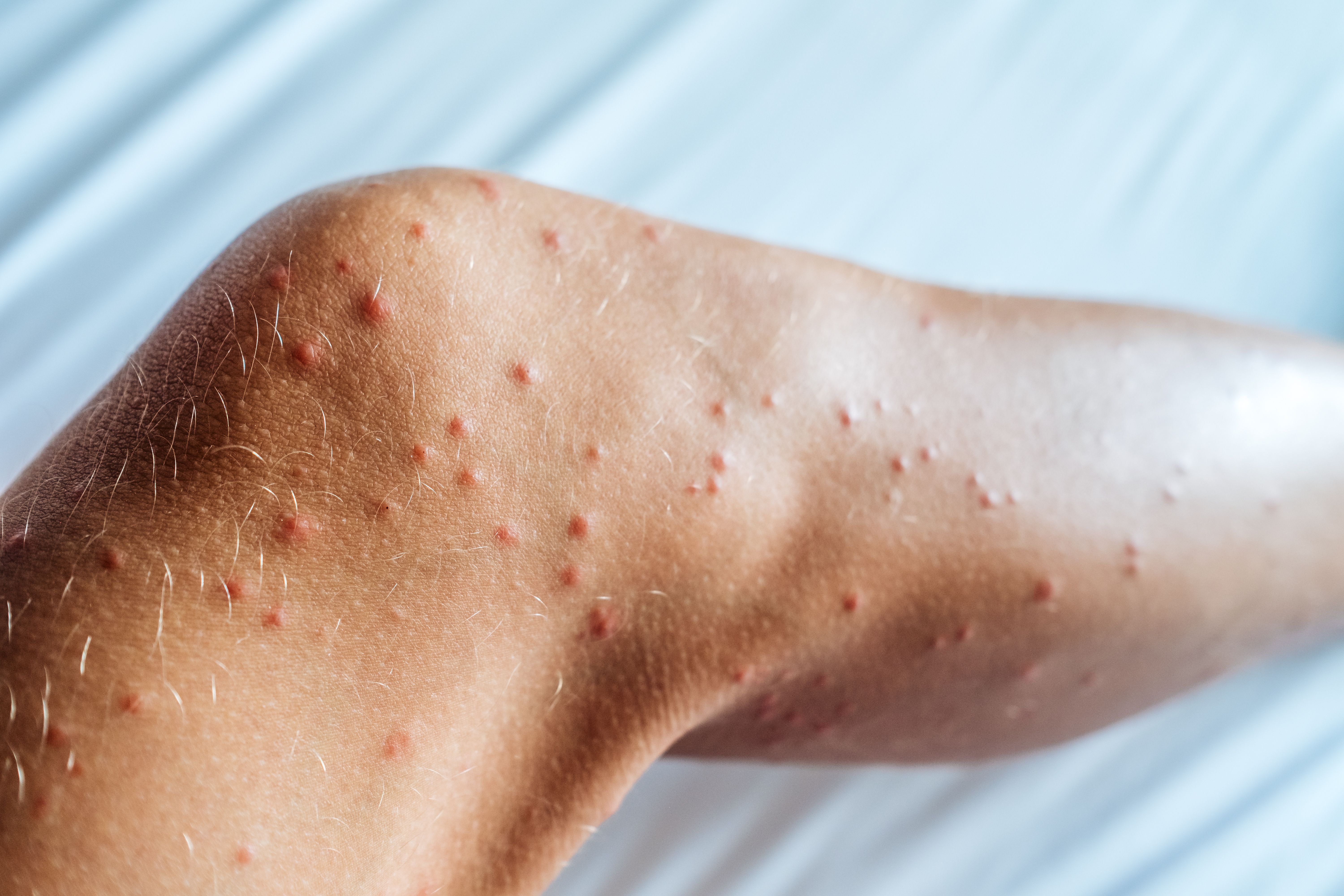 piqûres de punaises de lit