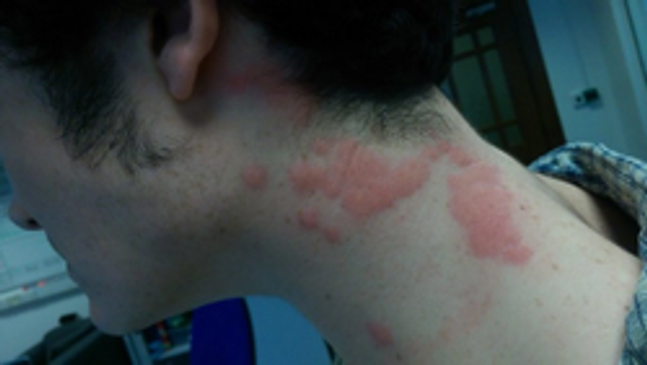 Image of Bed Bug Bites on neck