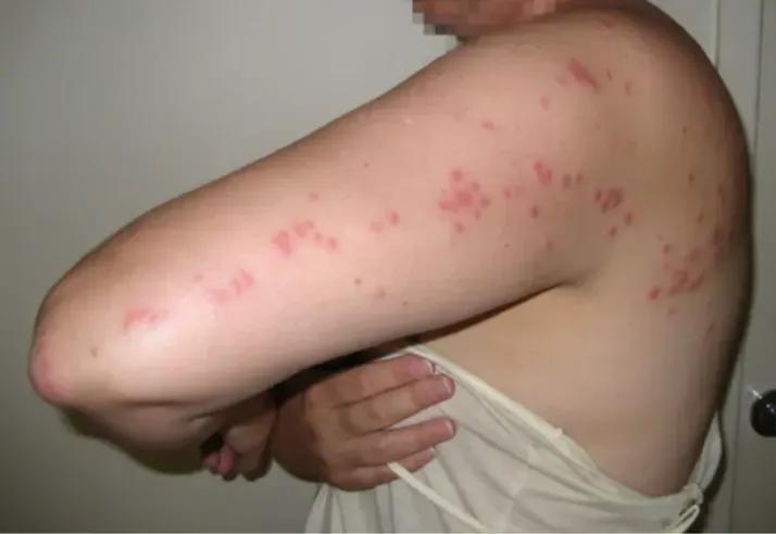 Image of Bed Bug Bites on hands and body