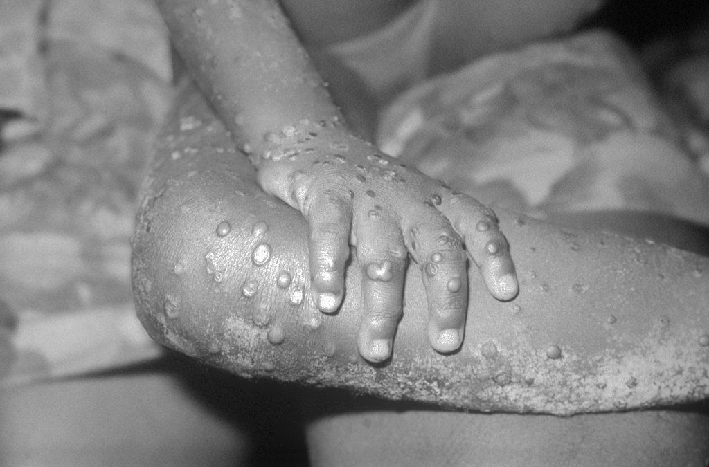 https://commons.wikimedia.org/wiki/File:Monkeypox.jpg