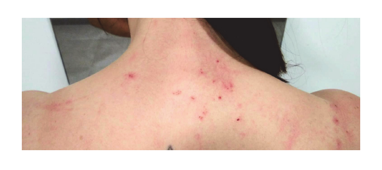 Dermatitis provocada por Ornithonyssus bacoti (Hirst, 1913) en la espalda de una persona. 