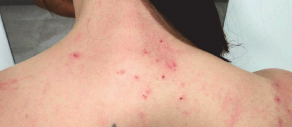 Dermatitis provocada por Ornithonyssus bacoti (Hirst, 1913) en la espalda de una persona. 