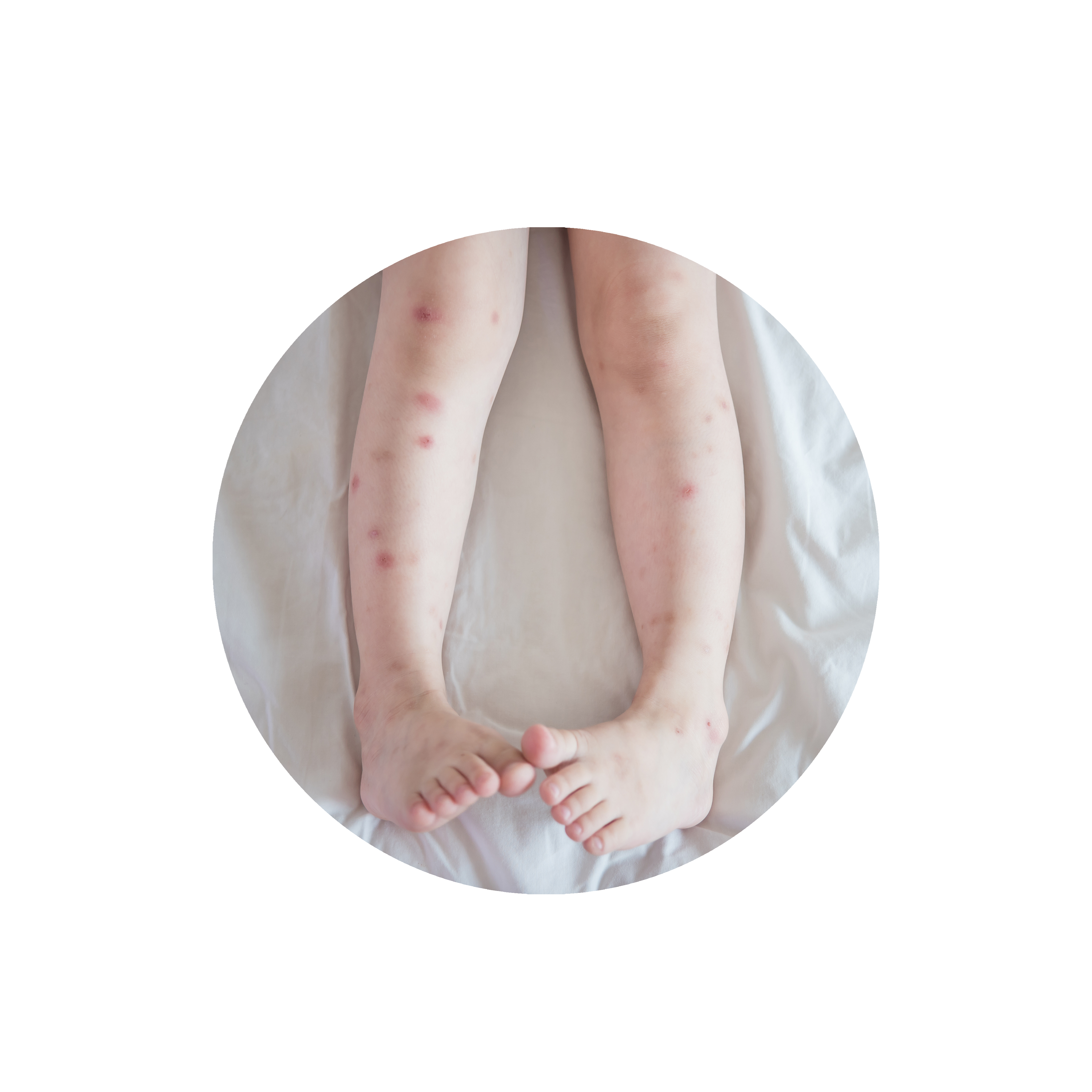 picadura-chinche-de-cama