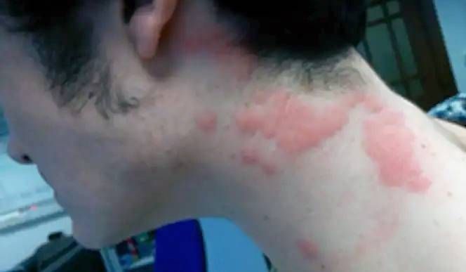 Nahaufnahme von Bettwanzenstichen am Hals einer Person, die als rote, juckende Flecken sichtbar sind. Bettwanzenbisse treten häufig in Reihen oder Clustern auf und können starken Juckreiz und Hautreaktionen verursachen.