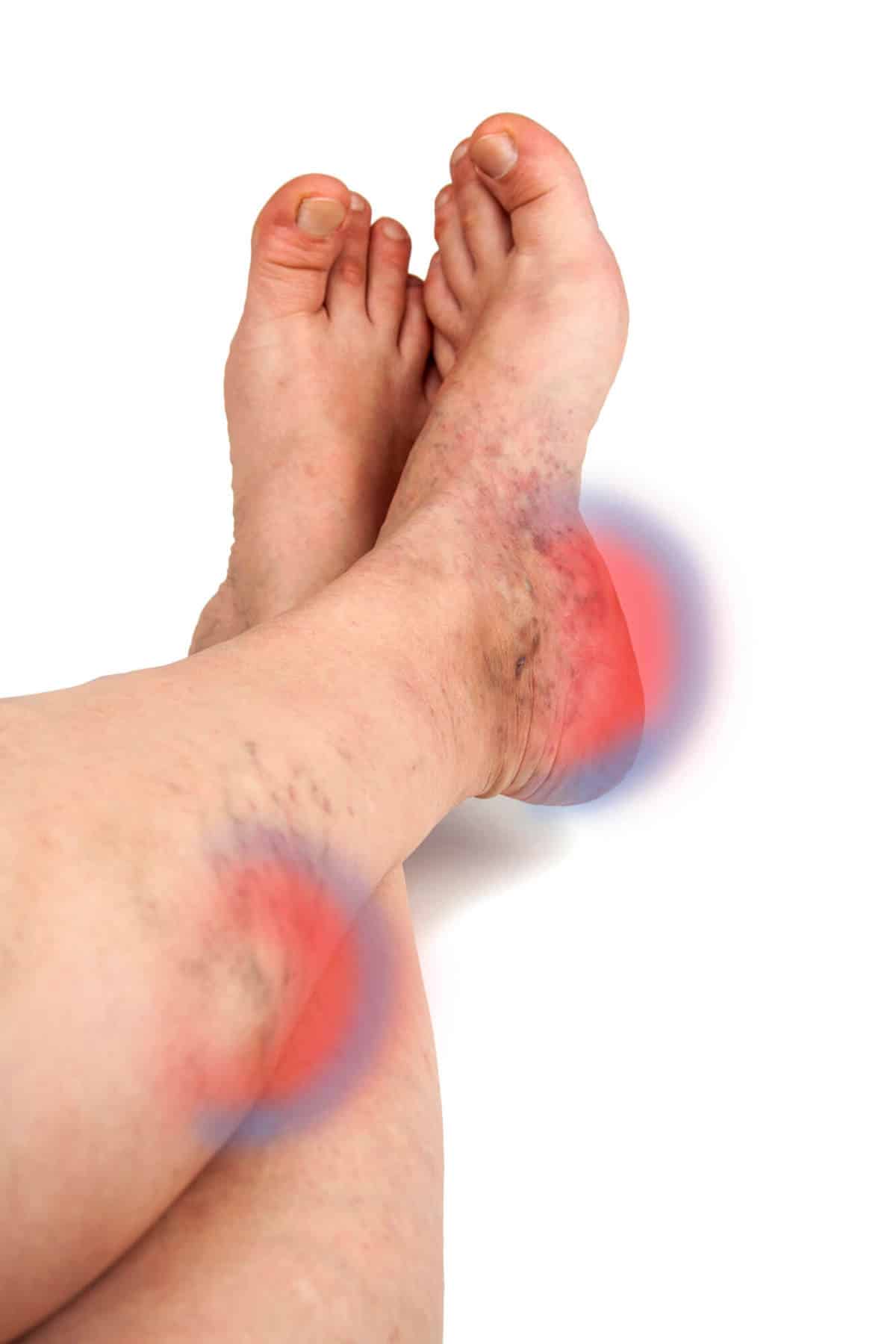 Varicose veins