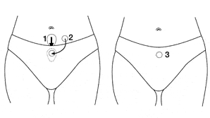 How LadyCare Works