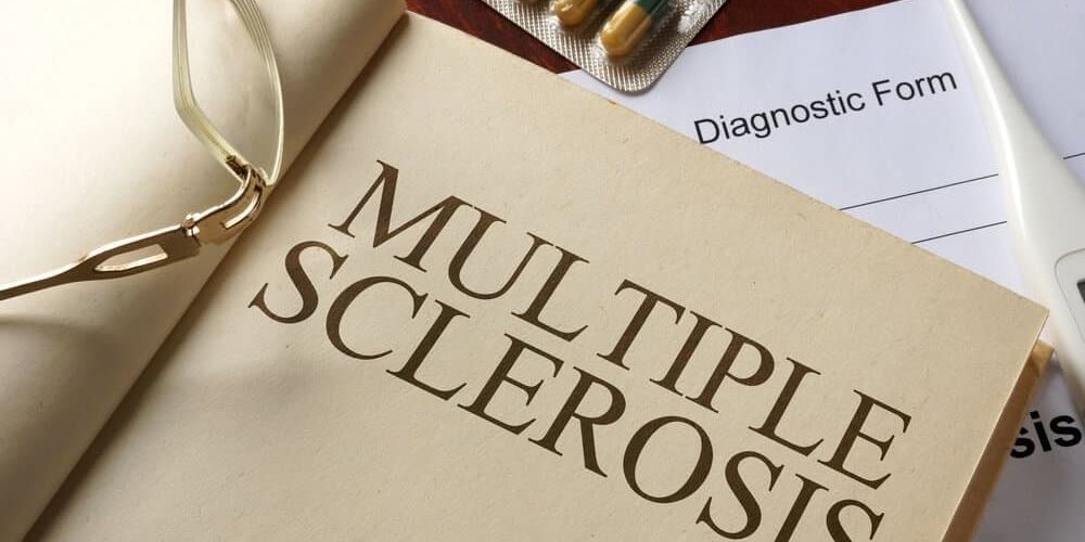 Finding Natural Treatment Options for Multiple Sclerosis