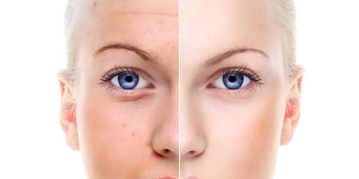 How to Use Essential Oils to Treat Acne