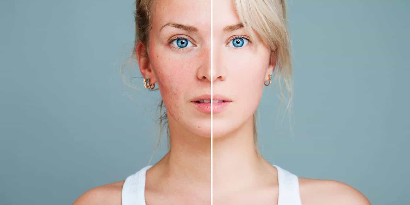 Rosacea