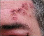 Shingles image