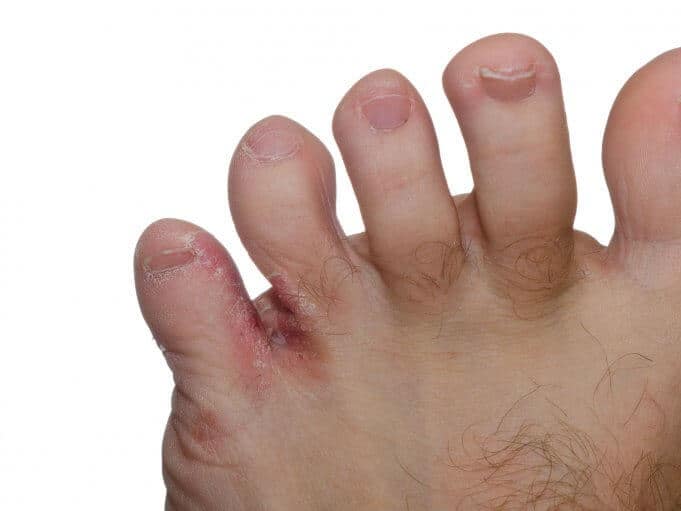 Foot fungus, athlete's foot