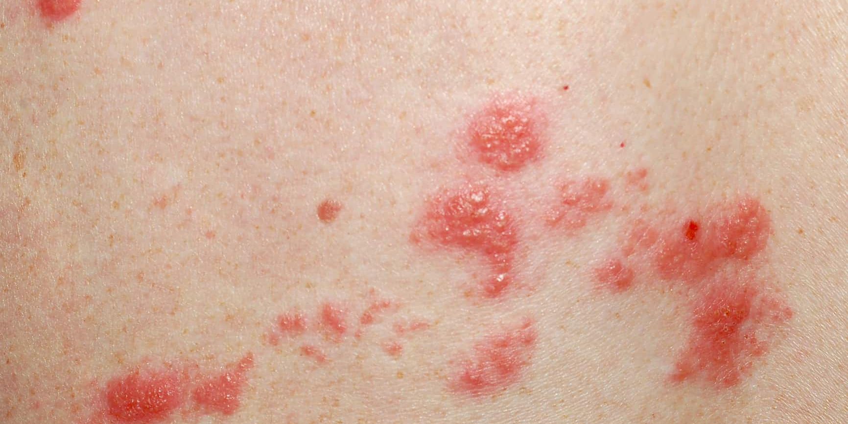 home remedies for shingles
