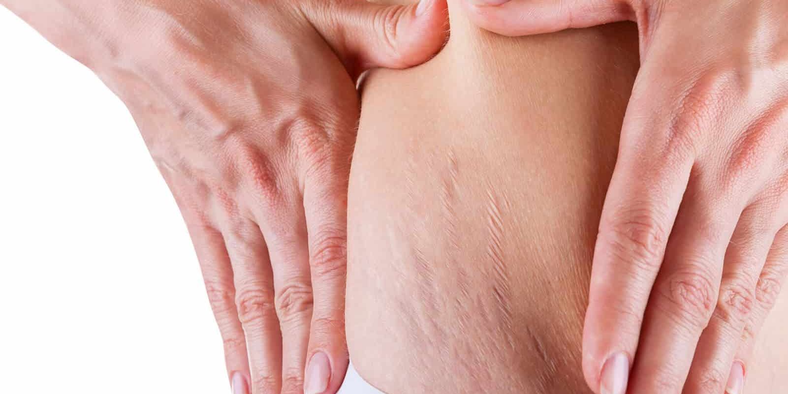 home remedies for stretch marks