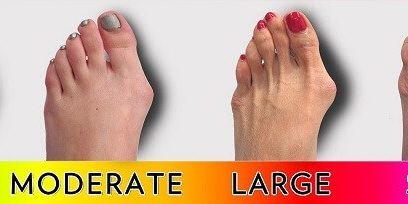 Bunions severity