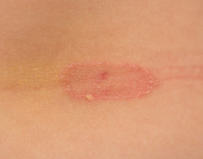 Ringworm