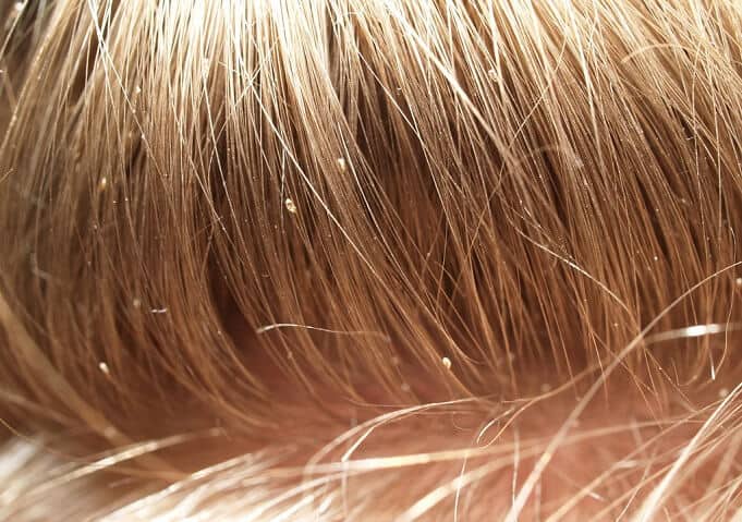 head lice