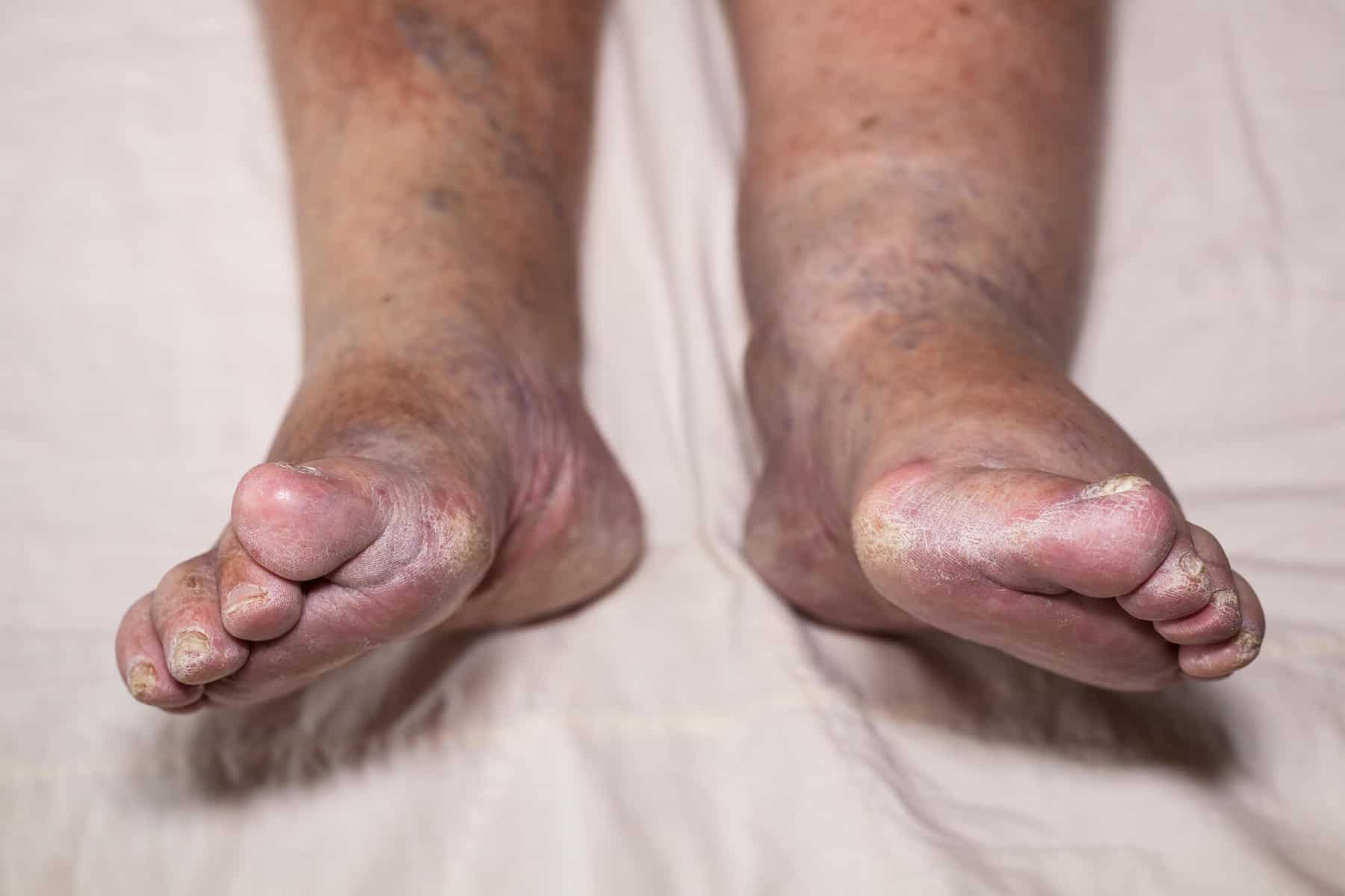 Swollen leg/ankle, Edema