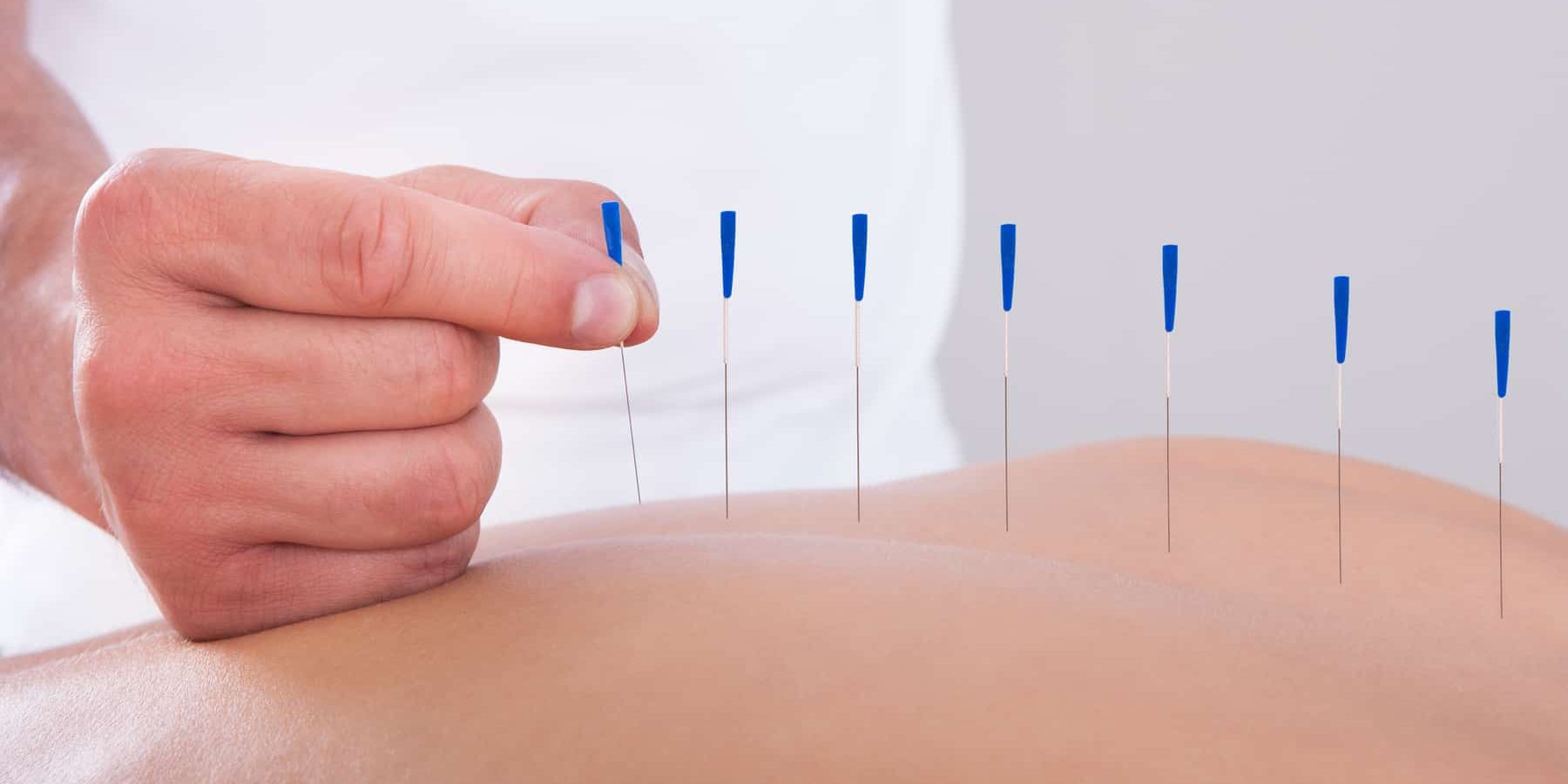 The Benefits of Dry Needling