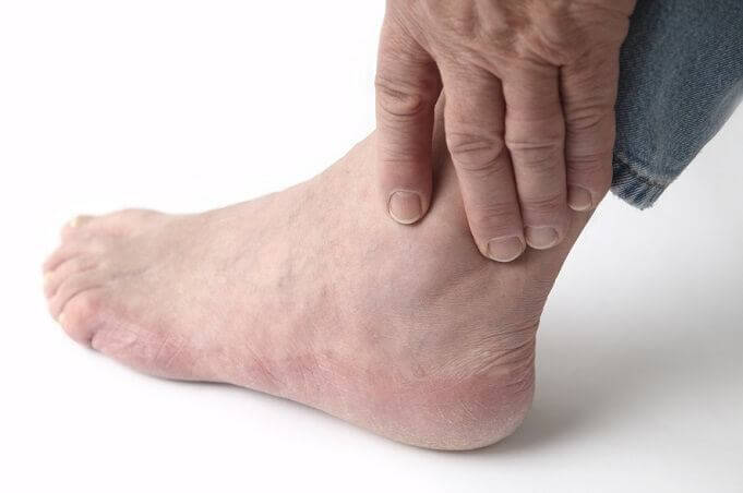 Gout