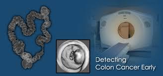 Nội soi ảo khung đại tràng bằng chụp CT Scan