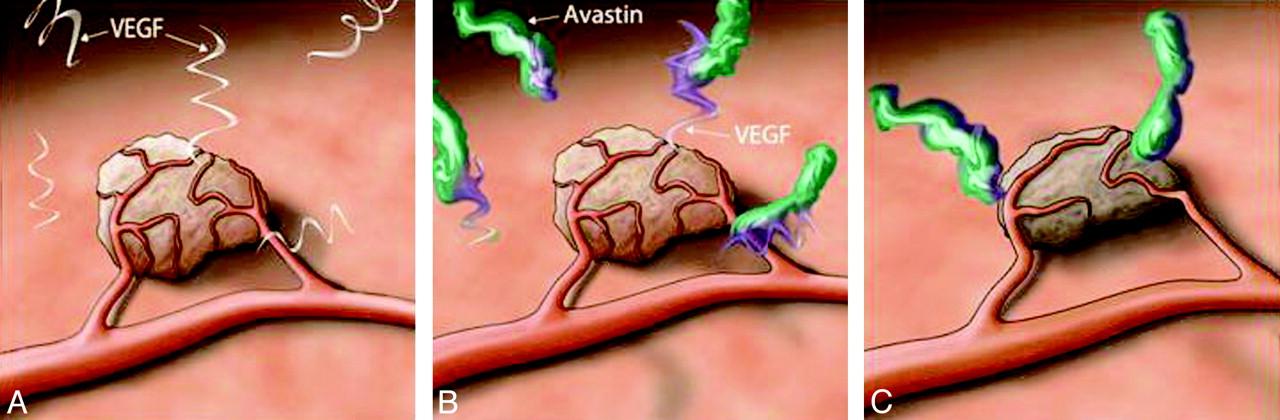 Hình minh họa 2: Hoạt động của Avastin. A: Khối u cần hình thành mạch máu mới để có các chất dinh dưỡng và oxy. VEGF thúc đẩy sự hình thành các mạch máu này. B & C: Avastin có thể "khoá" và vô hiệu hoá VEGF, dẫn đến khối u không thể hình thành mạch máu mới và bị "bỏ đói".  ( 11)