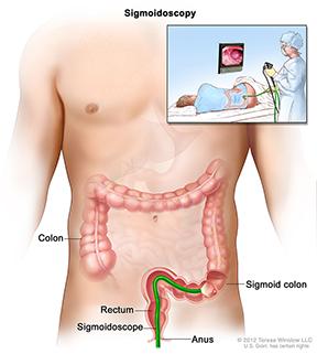 Nội soi đại tràng sigmoid