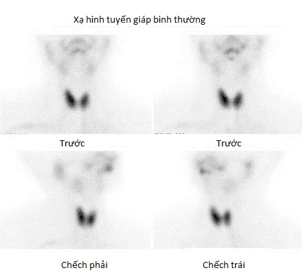 Ảnh chụp xạ hình tuyến giáp