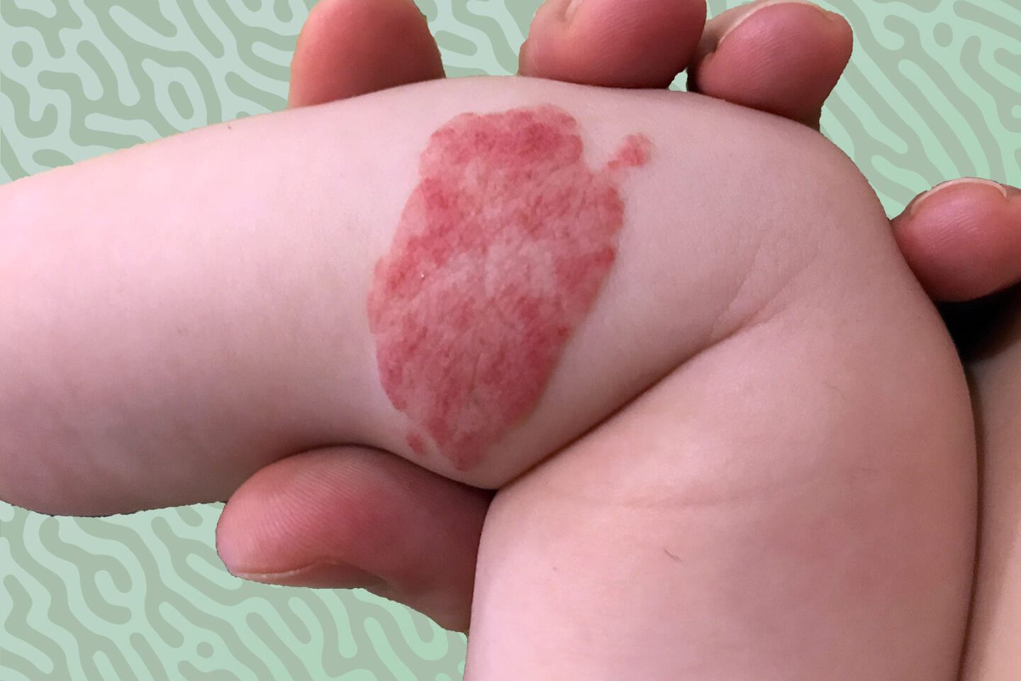 U máu trên da ở trẻ em có gây ung thư hay không? thumbnail.