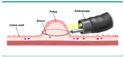 Cắt bỏ polyp trong khi nội soi đại tràng