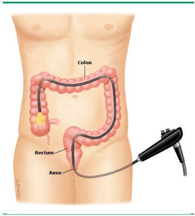 Trong quá trình nội soi đại tràng, bạn nằm nghiêng về một phía. Bác sĩ sẽ đặt một ống soi mềm có gắn camera vào hậu môn (từ phía sau). Sau đó, bác sĩ đẩy ống vào trực tràng và đại tràng. Camera sẽ gửi hình ảnh bên trong lòng đại tràng của bạn tới màn hình máy tính.