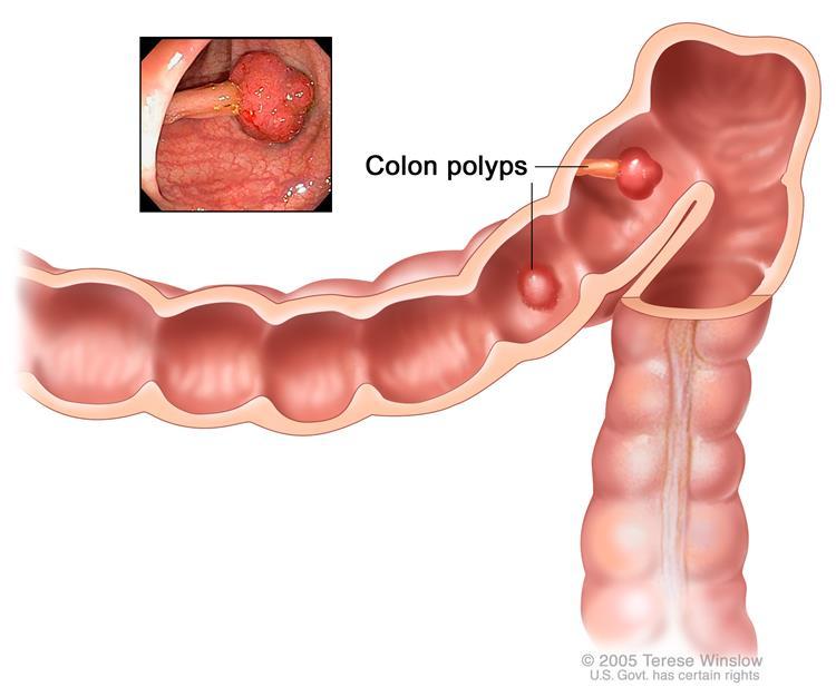 Hình ảnh minh hoạ và ảnh nội soi thật về polyp trong đại tràng. 