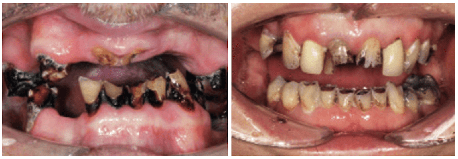 Hình 2. Đa sâu răng do xạ trị