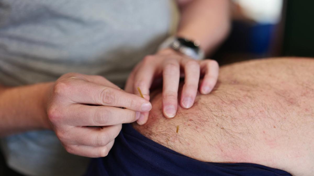 Close-up of dry needling treatment