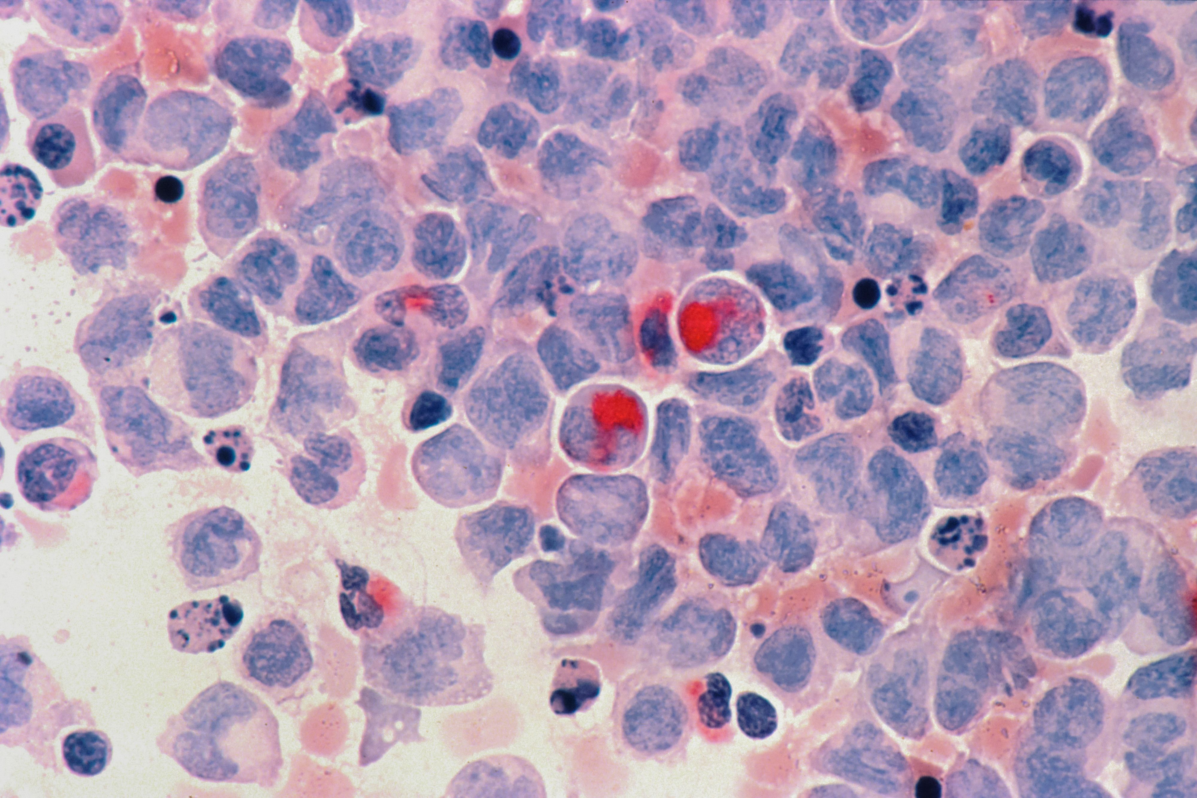 Chronic Lymphocytic Leukemia (CLL): Overview