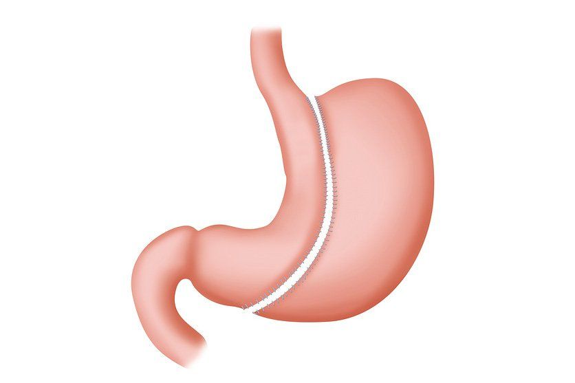 Should You Consider Weight Loss Surgery?