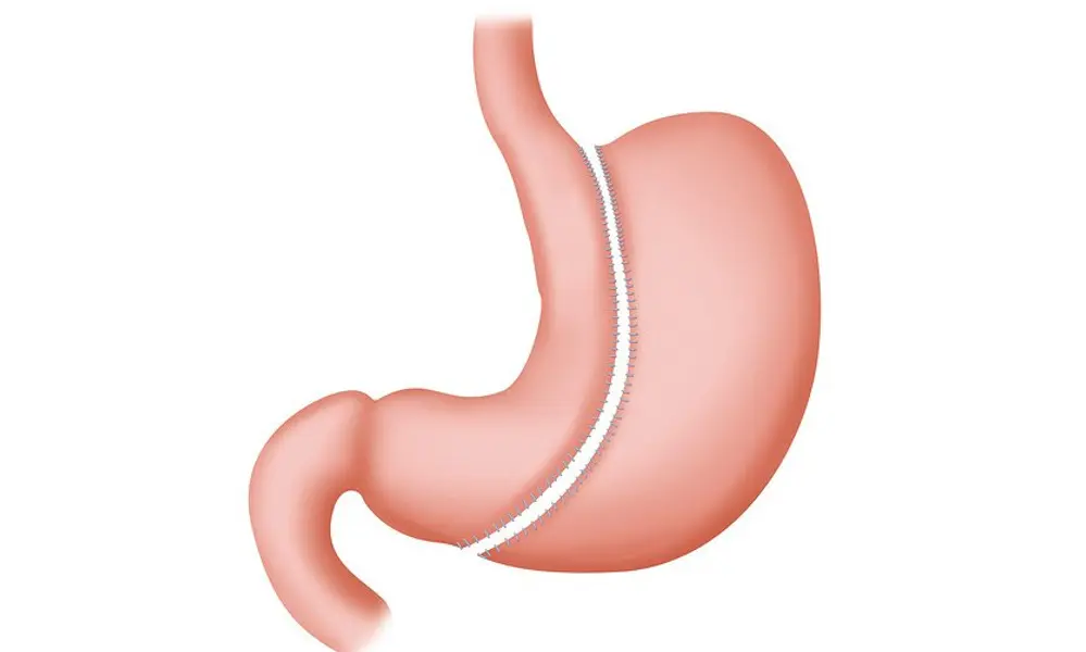 Should You Consider Weight Loss Surgery?