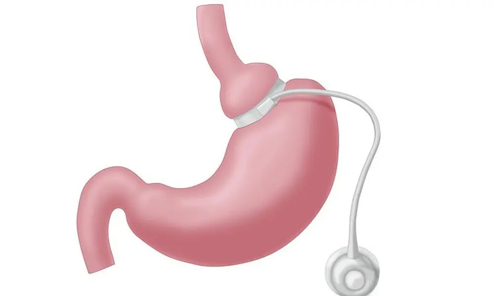 Should You Consider Weight Loss Surgery?