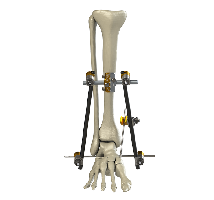External Fixation