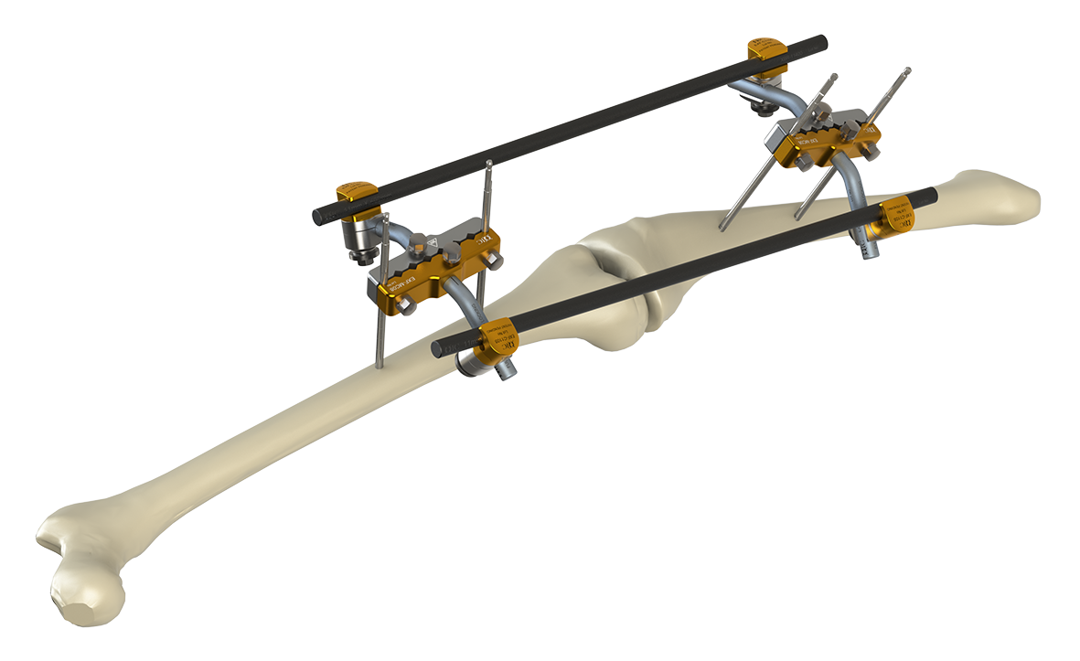 External Fixation
