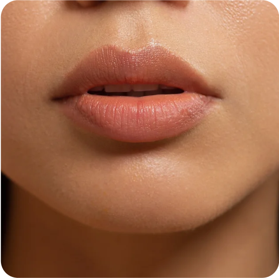 LIP FILLER