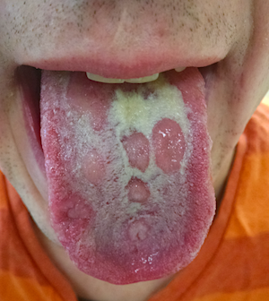 2599 syphilis OK