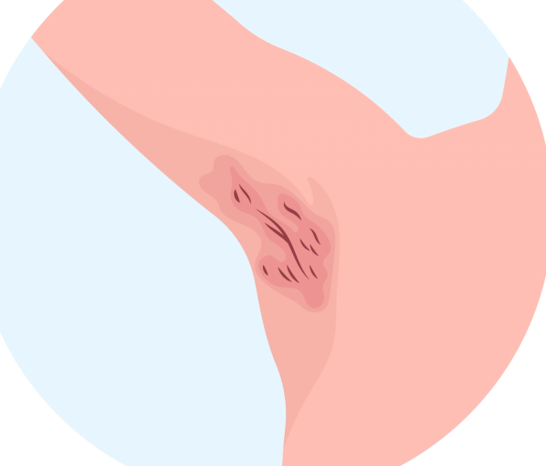 Dr.Dropin | Hidradenitis suppurativa | Inflammation of the sweat glands