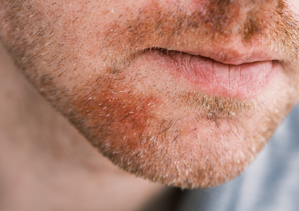 Drool Rash In Adults Dr.Dropin | Perioral dermatitis | Causes and symptoms | Dr.Dropin