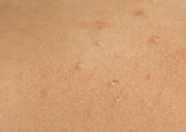 Pearl Rash Dr.Dropin | Molluscum contagiosum: Symptoms, Causes and Treatment
