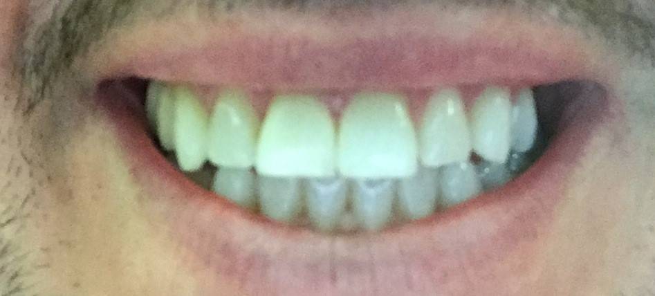 After composite bonding on patient showing no gap between front teeth
