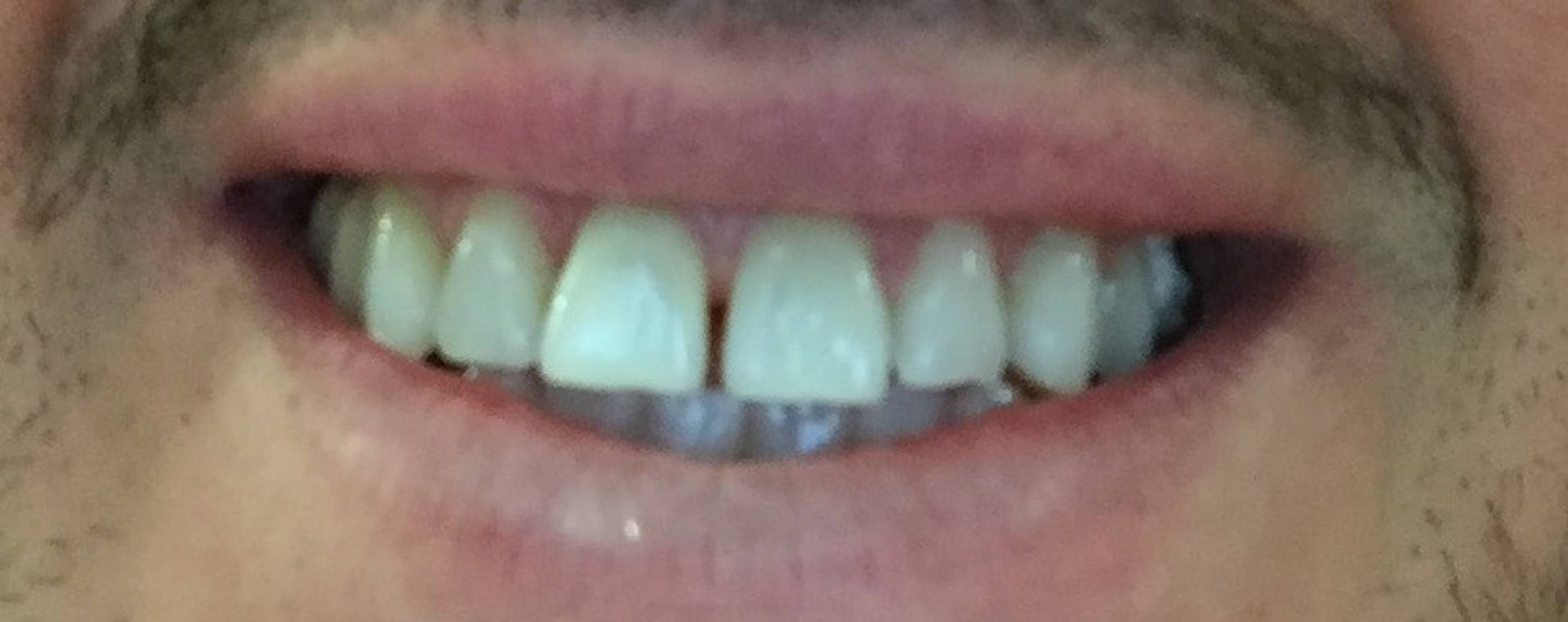 Before composite bonding on patient showing gap between front teeth